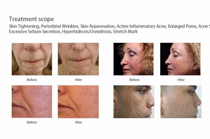 Microneedling Morpheus 8 Ouro RF Apertar a pele facial N&atilde;o cir&uacute;rgico Recupera&ccedil;&atilde;o fracion&aacute;ria
